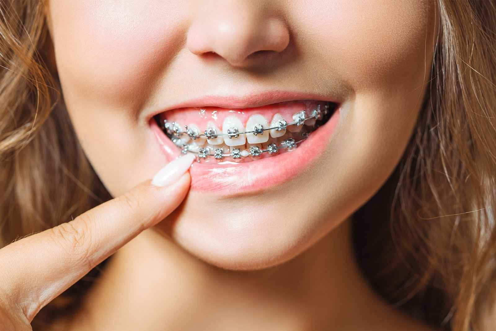 Self-Ligating Braces: How They Work And What Makes Them Effective